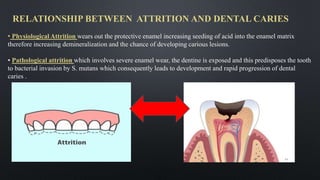 RELATIONSHIP BETWEEN ATTRITION AND DENTAL CARIES
• Physiological Attrition wears out the protective enamel increasing seeding of acid into the enamel matrix
therefore increasing demineralization and the chance of developing carious lesions.
• Pathological attrition which involves severe enamel wear, the dentine is exposed and this predisposes the tooth
to bacterial invasion by S. mutans which consequently leads to development and rapid progression of dental
caries .
44
 