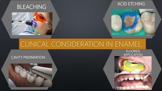 CLINICAL CONSIDERATION IN ENAMEL
BLEACHING
ACID ETCHING
CAVITY PREPARATION
FLUORIDE
APPLICATION
46
 