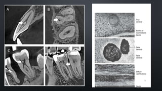 CALCIFICATION OF PULP
True denticles
Its structure is similar to dentin.
They exhibit dentinal tubules containing the processes
of the odontoblasts that exist on their surface. They are
rare and are usually located near the apical foramen.
False denticles
These denticles do not exhibit dentinal tubules but
appear as concentric layers of calcified tissue.
The surrounding pulp tissue may appear quite
normal. They are seen more frequently in the
coronal pulp.
73
 