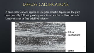 Diffuse calcifications appear as irregular calcific deposits in the pulp
tissue, usually following collagenous fiber bundles or blood vessels .
Larger masses or fine calcified spicules.
DIFFUSE CALCIFICATIONS
74
 