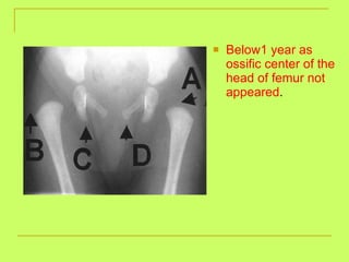 Below1 year as ossific center of the head of femur not appeared . 