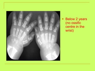 Below 2 years (no ossific centre in the wrist) 