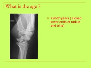 What is the age ? >20-21years ( closed lower ends of radius and ulna) 