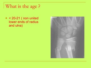 What is the age ? < 20-21 ( non united lower ends of radius and ulna) 