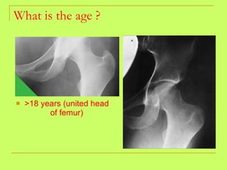 What is the age ? >18 years (united head of femur) 