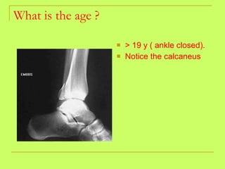 What is the age ? > 19 y ( ankle closed). Notice the calcaneus   