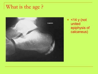 What is the age ? <14 y (not united epiphysis of calcaneus) 