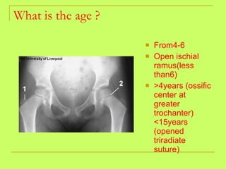 What is the age ? From4-6 Open ischial ramus(less than6) >4years (ossific center at greater trochanter) <15years (opened triradiate suture) 