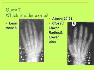 Quest.7 Which is older a or b? Less than18 Above 20-21 Closed  Lower  Radius& Lower ulna 