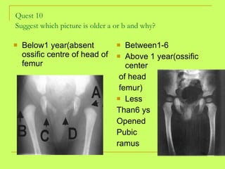 Quest 10 Suggest which picture is older a or b and why?   Below1 year(absent ossific centre of head of femur Between1-6 Above 1 year(ossific center of head femur) Less Than6 ys Opened Pubic  ramus 