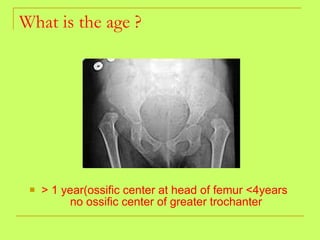 What is the age ? <ul><li>> 1 year(ossific center at head of femur <4years  no ossific center of greater trochanter </li><...