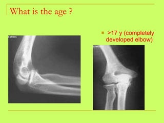 What is the age ? <ul><li>>17 y (completely developed elbow)   </li></ul>
