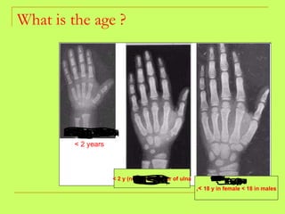 What is the age ? < 2 years < 2 y (no ossifc center of ulna ,<  18 y in female < 18 in males 