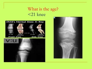 What is the age? <21 knee 