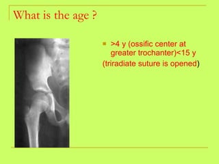 What is the age ? <ul><li>>4 y (ossific center at greater trochanter)<15 y  </li></ul><ul><li>(triradiate suture is opened...