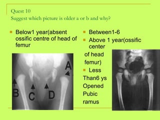 Quest 10 Suggest which picture is older a or b and why?   <ul><li>Below1 year(absent ossific centre of head of femur </li>...