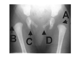 Age estimation by bones | PPTX