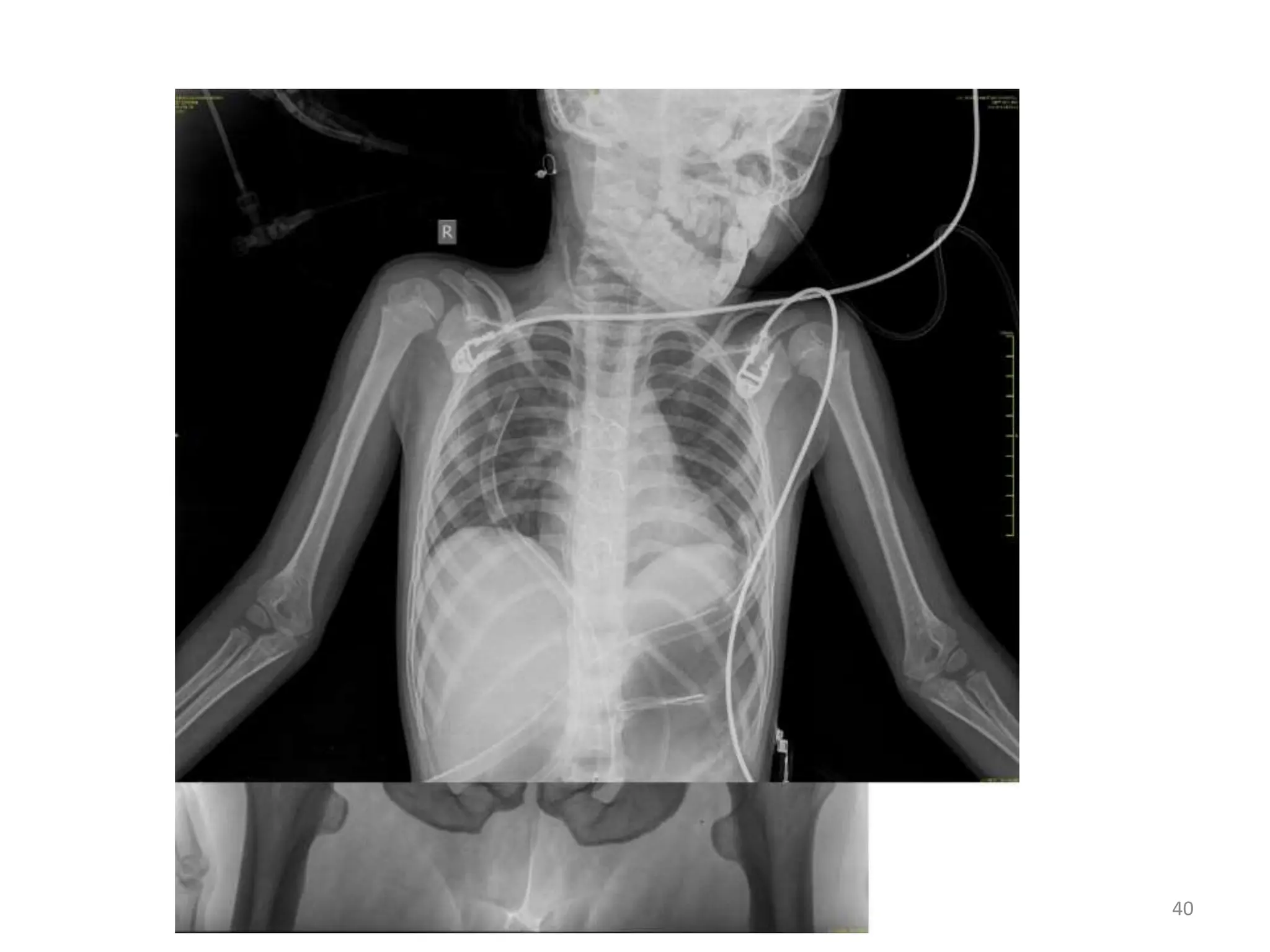 Age estimation by radiological method (using X-rays) | PPTX