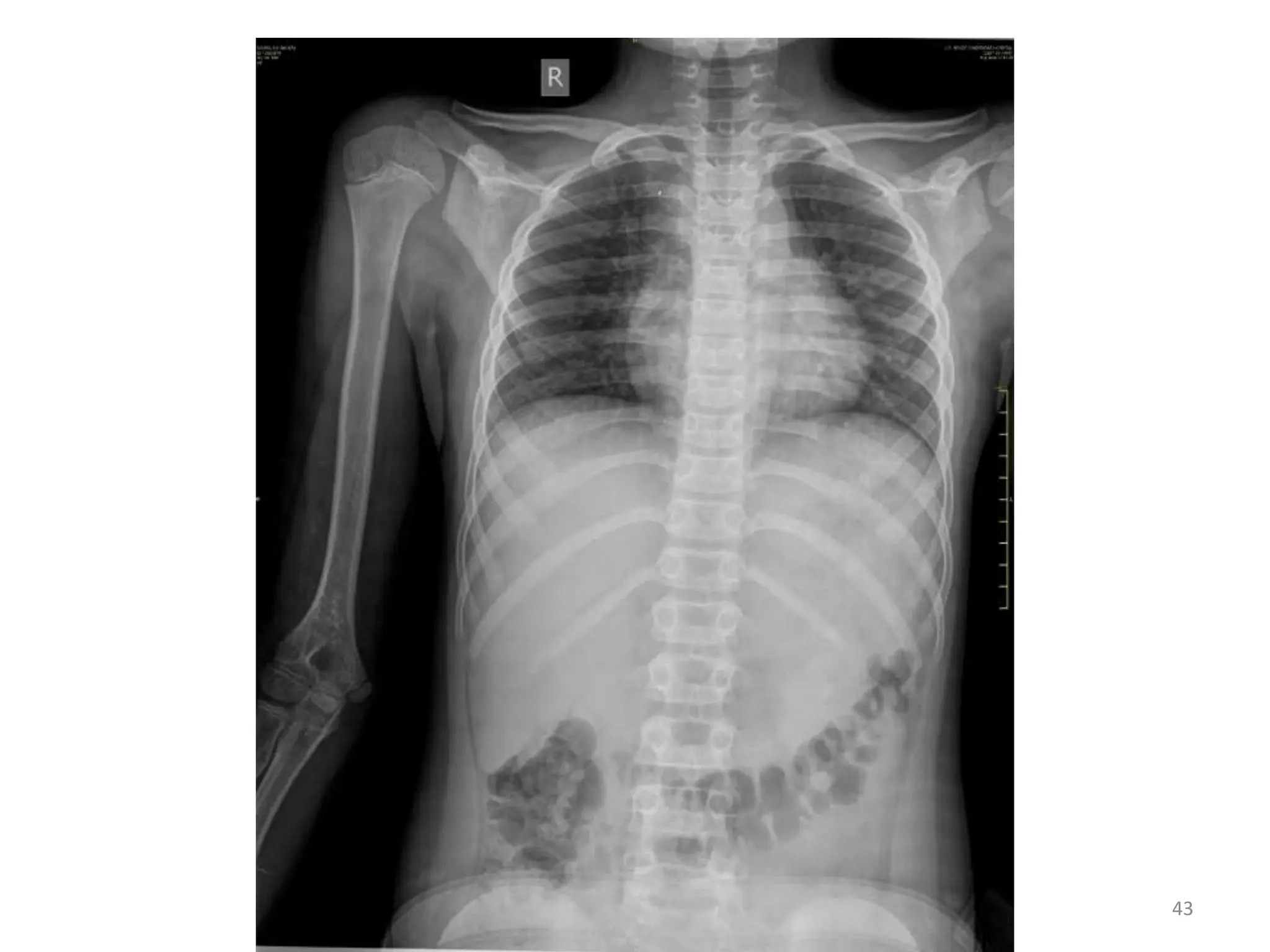 Age estimation by radiological method (using X-rays) | PPTX