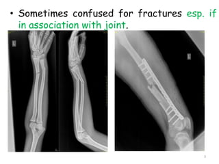• Sometimes confused for fractures esp. if
in association with joint.
3
 