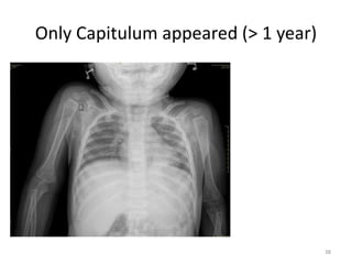 Only Capitulum appeared (> 1 year)
38
 