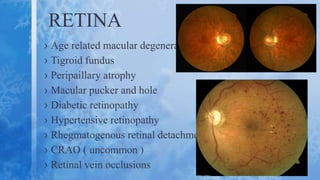 AGEING AND EYE.pptx