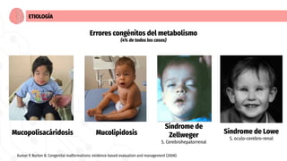 ETIOLOGÍA
Mucolipidosis
Errores congénitos del metabolismo
(4% de todos los casos)
Mucopolisacáridosis
Síndrome de
Zellweg...