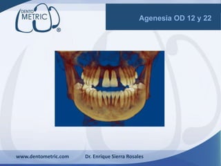 www.dentometric.com Dr. Enrique Sierra Rosales
Agenesia OD 12 y 22
 
