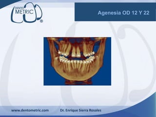 www.dentometric.com Dr. Enrique Sierra Rosales
Agenesia OD 12 Y 22
 