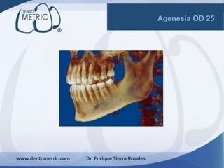 www.dentometric.com Dr. Enrique Sierra Rosales
Agenesia OD 25
 