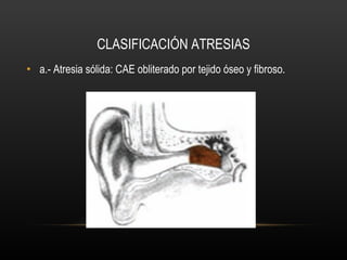 Agenesia Y Atresia Del Conducto Auditivo Externo PPT Agenesia Y Atresia Del Conducto Auditivo Externo PPT