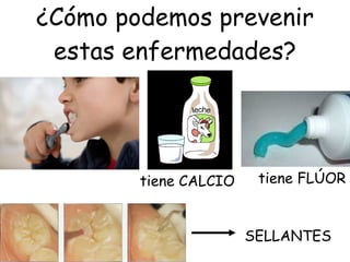 ¿Cómo podemos prevenir estas enfermedades? SELLANTES tiene CALCIO tiene FLÚOR 