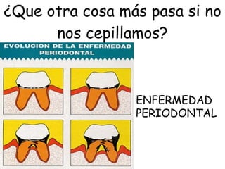 ¿Que otra cosa más pasa si no nos cepillamos? ENFERMEDAD PERIODONTAL 
