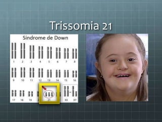 Trissomia 21
 
