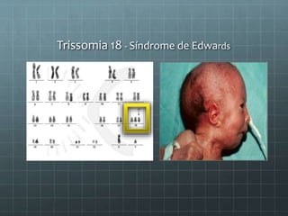 Trissomia 18 - Síndrome de Edwards
 