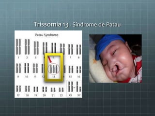 Trissomia 13 - Síndrome de Patau
 
