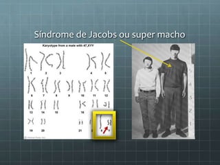 Síndrome de Jacobs ou super macho
 