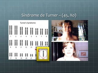Síndrome de Turner – (45, X0)
 