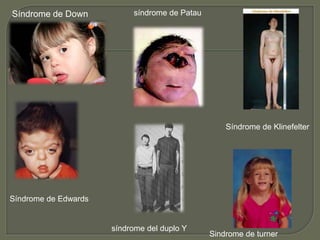 Síndrome de Down 
Síndrome de Edwards 
síndrome de Patau 
Síndrome de Klinefelter 
síndrome del duplo Y 
Sindrome de turner 

