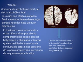 *Alcohol
síndrome de alcoholismo fetal y el
efecto alcohólico fetal
Los niños con efecto alcohólico
fetal a menudo tienen desventajas
porque no se les hace un buen
diagnóstico
El trastorno no es reconocido y
estos niños sufren por ello Su
comportamiento puede parecer
beligerante u obstinado, mientras
que en realidad el trastorno de
conducta de estos niños proviene
de la poca comprensión que tienen
de lo que se espera de ellos
Cerebro de un niño normal a
la (izquierda ) cerebro de un
niño con síndrome
alcohólico de la misma edad
a la (DERECHA )
 