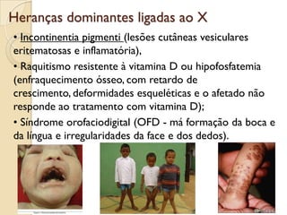Heranças dominantes ligadas ao X
• Incontinentia pigmenti (lesões cutâneas vesiculares
eritematosas e inflamatória),
• Raquitismo resistente à vitamina D ou hipofosfatemia
(enfraquecimento ósseo, com retardo de
crescimento, deformidades esqueléticas e o afetado não
responde ao tratamento com vitamina D);
• Síndrome orofaciodigital (OFD - má formação da boca e
da língua e irregularidades da face e dos dedos).
 