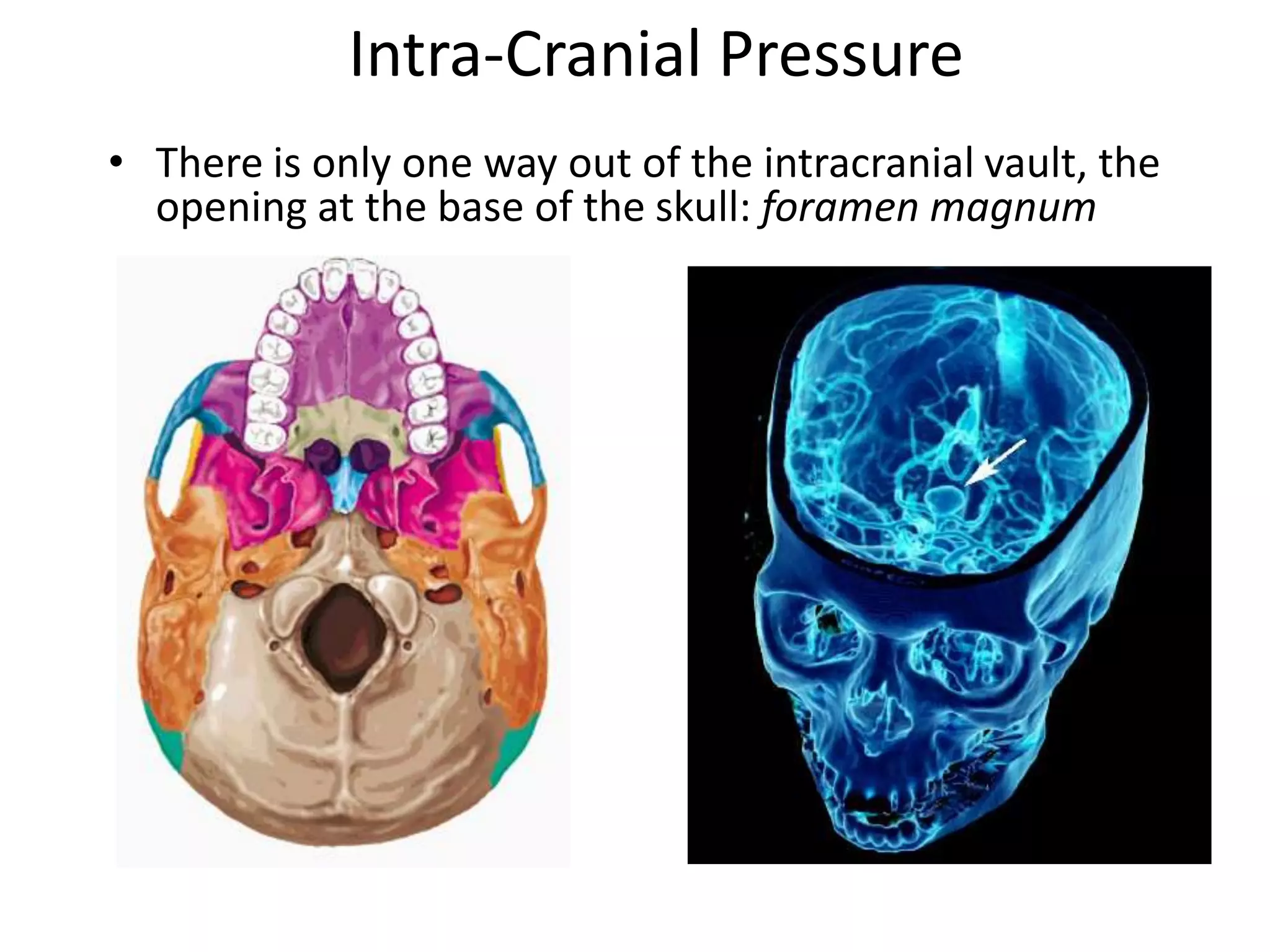 Intra-Cranial Pressure
• There is only one way out of the intracranial vault, the
  opening at the base of the skull: foramen magnum
 