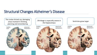 Structural Changes Alzheimer’s Disease
The cortex shrivels up, damaging
areas involved in thinking,
planning and remembering
Shrinkage is especially severe in
the hippocampus
Ventricles grow larger
 