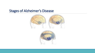 Stages of Alzheimer’s Disease
 