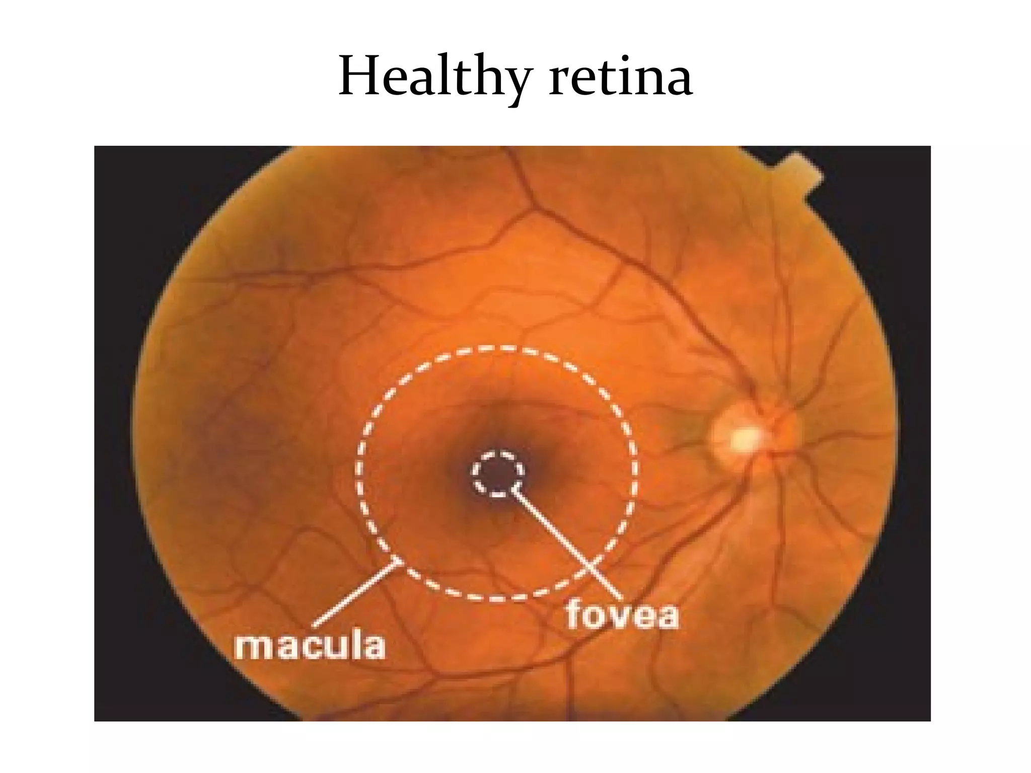Age related macular degeneration from Optometrist Point of View | PPT