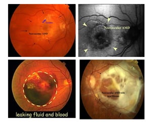 Age related macular degeneration from Optometrist Point of View | PPT