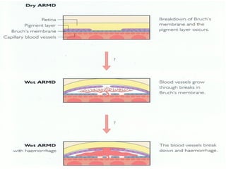 Age related macular degeneration from Optometrist Point of View | PPT