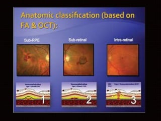 Age related macular degeneration | PPTX