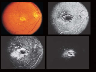 Age related macular degeneration | PPTX