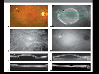 Age related macular degeneration | PPTX